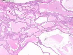 If untreated, the malignant cells will continue to divide, grow and invade surrounding areas of the body. Webpathology Com A Collection Of Surgical Pathology Images