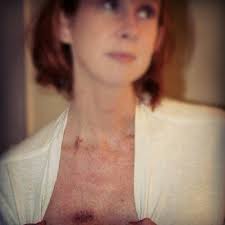Port Surgery Site Dysautonomia Pots Dysautonomia Surgery
