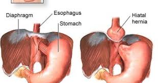Hiatus Hernia Info February 2012 Hiatus Hernia Gastric Sleeve Gastric Sleeve Surgery