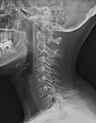 Normal Radiographic Anatomy Of The Cervical Spine Radiologia Anatomia Cuerpo