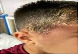 Image result for Tinea Capitis