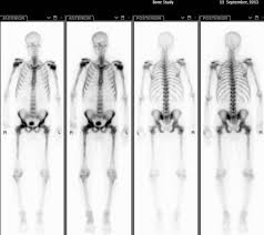 The reverse is the case in a tumor. Superscan Due To Metastatic Prostate Cancer Radiology Case Radiopaedia Org