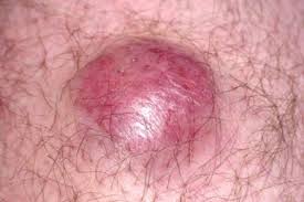 Image result for Merkel Cell Carcinoma