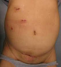 Laparoscopic Surgery Condition Ck Ng Urology Minimally Invasive Surgery