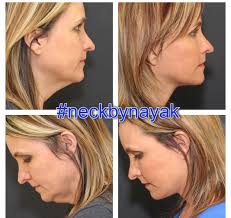 Before And After Pictures Of Plastic Surgery Performed By L Mike Nayak Md Of Nayak Plastic Surgery Plastic Surgery Chin Liposuction Face Lift Surgery