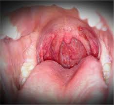 Image result for Hand foot and mouth disease HFMD roof of mouth