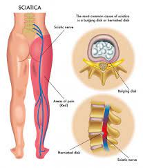 A slipped disc can be very painful, but what causes it, and how is it treated? Causes Of Sciatica And Sciatic Nerve Pain
