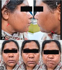 Bilateral tuberculous parotitis with facial nerve palsy: The first case  report