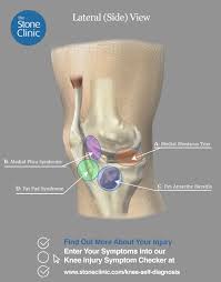 Image result for Knee Bulge Sign