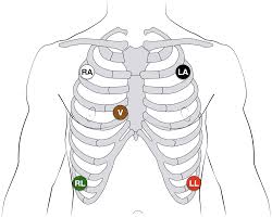 Meaning of bipolar lead medical term. Ecg Lead Positioning Litfl Ecg Library Basics