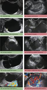 Ovarian cancer (cancer of the ovaries). Ultrasound Imaging In Ovarian Masses Benign Or Malignant Chapter 21 Ultrasonography In Gynecology