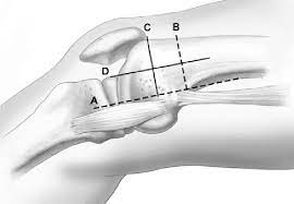 We had a flap tear of the articular cartilage based medially and coming out of the notch and the entire area of the femoral condyle. Quadrants Of Perforators In The Medial Femoral Condyle Flap The Download Scientific Diagram