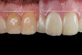Luckily, many of today's dentists and periodontists (gum specialists) are quite capable of performing the gum contouring procedure. Bleaching Restoring And Gum Contouring