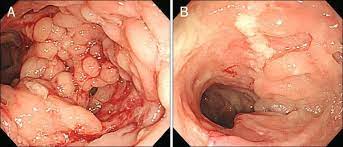 Ulcerative Colitis-Causes-Symptoms-Diagnosis-Treatment-Pakistan's Best Homeopathic doctor-Dr Qaisar Ahmed-Al-Haytham clinic-Risalpur-KPK