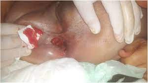 Some types of skin cancer are more dangerous than others, but if you have a spot. Perineal Skin Recurrence On The Site Of Lone Star Retractor Case Report Surgical Case Reports Full Text