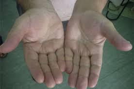 Unilateral asterixis in rarely reported in association with thalamic lesions and usually develops as an immediate postictal phenomenon. Liver Pain An Overview Sciencedirect Topics