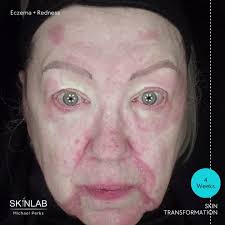Skinlab Michael Perks