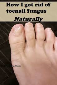 How I Got Rid Of Toenail Fungus Quickly Naturally Nail Fungus Remedy Nail Fungus Cure Toenail Fungus