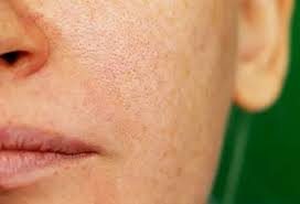 Image result for Melasma
