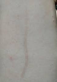 The scars we are left with are not only embarrassing, but can be a constant reminder of our once horrible skin, and worst of all, negatively. Skin Concern How Do I Improve The Color Of This Scar Skincareaddiction
