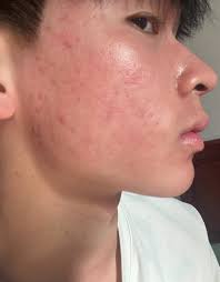 When that pimple gets in the way💞💞💞