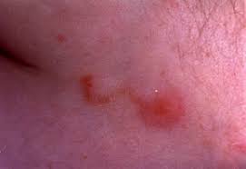 Image result for scabies bite
