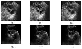 A study to determine the range of bone density in british females was carried out on a group of 165 normal women. Follicle Detection And Ovarian Classification In Digital Ultrasound Images Of Ovaries Intechopen