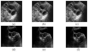 A study to determine the range of bone density in british females was carried out on a group of 165 normal women. Follicle Detection And Ovarian Classification In Digital Ultrasound Images Of Ovaries Intechopen