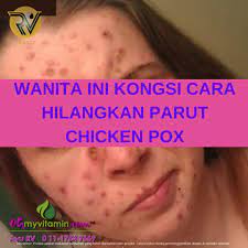 Cara hilangkan jeragat dengan berkesan agar kulit tidak rosak. Wanita Ini Kongsi Cara Hilangkan Parut Chicken Pox Coach Bisnes Coach Detox Kurus Coach Penyusuan Susu Ibu Mentor Bisnes Pengedar Shaklee Pengedar Youth Pengedar Vivix 011 17547669