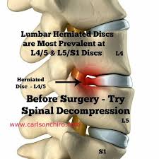 Spinal Decompression For Herniated Discs Herniated Disc Spinal Decompression Herniated