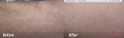 Arms laser hair removal gains the attention of both men and women. Laser Hair Removal Williamsport Pa Bng Aesthetics Skin Laser Center