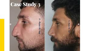 Dr Mustafa Yanik is a rhinoplastic surgeon known