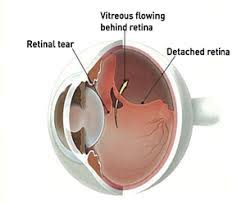 The goal is to keep fluid from going through the. Detached And Torn Retina Retina Specialists Eye Surgery Retina Associates Cameron Javid Md