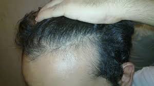 Well i'm in my 30s and i have/had hair loss at the crown (type iii vertex), a circle like hair loss at the back of my head, it was pretty evident, also a tiny bit of thinning in the front. Rogaine Nizoral 1 Update 1months And 3 Weeks Hairlosstalk Forums
