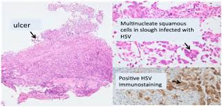 The virus is similar to that of herpes simplex and cmv with intranuclear inclusions. Infective Esophagitis Inhaled Steroids Treatment For Eosinophilic Esophagitis Not Always Safe Medcrave Online