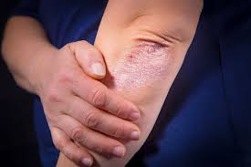 Les pertes blanches sont sécrétées par le col de l'utérus et par le vagin. Psoriasis Principe Symptomes Traitement Top Sante