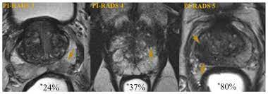 These include your blood pressure, heart rate and metab. Likelihood Of Significant Prostate Cancer Detection By Mri Suspicion Download Scientific Diagram