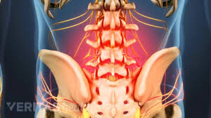 Symptoms in the low back can be a result of problems in the bony lumbar spine, discs between the vertebrae, ligaments around the spine and discs, spinal cord and nerves, muscles of the low back, internal organs of the pelvis and abdomen, and the skin covering the lumbar area. Is Your Lower Back Pain Serious Advanced Spine And Pain Clinic