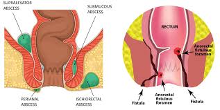 Image result for Perirectal Abscess