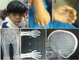 A Girl With Maroteaux Lamy Syndrome She Had Coarse Facial Features Download Scientific Diagram