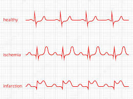 Heart Cardiogram Vector Charts Set Healthy Heart Rhythm