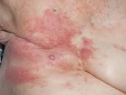 Symptoms of inflammatory breast cancer rash include the following: Carcinoma Erysipeloides Dermnet Nz