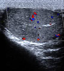 Any lump, enlargement, hardness, pain, or. Testicular Pain Wikipedia