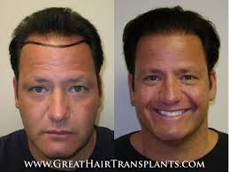 Natural Hair Loss Treatment in California Sonoma Sheridan