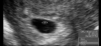 Se muestra con una forma circular oscura y se puede ver a través de una ecografía vaginal. Huevo Huero O Embarazo Anembrionario Cuando La Gestacion Es Fallida
