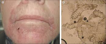 Image result for Demodex brevis