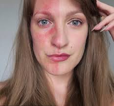 If you have any questions, ask your doctor or. Skin Care Routine For Rosacea From A Real Beauty Editor