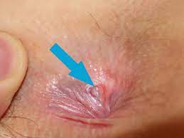 Bump on the anus: 7 causes and their treatments