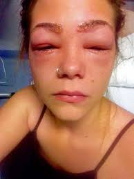 Her entire head swelled up as a result of, what she later learned was an allergy to paraphenylenediamine (ppd), a chemical widely used in permanent hair dye thanks to its ability to stick to strands through washes and styling without. Drogerie Farbemittel Veratzt Gesicht Von 16 Jahriger