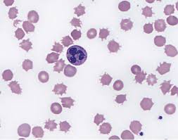 Image result for Anemia angolensis
